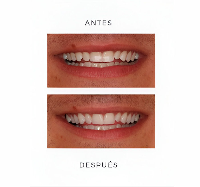 Infiltración con resina