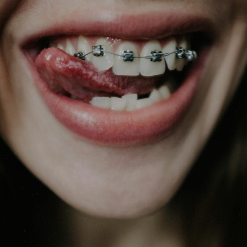 Dientes amontonados | Clínica Dental Valencia Marien Morata