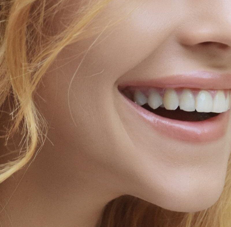 Contorneado dental | Clinica Dental Valencia Marien Morata Roig