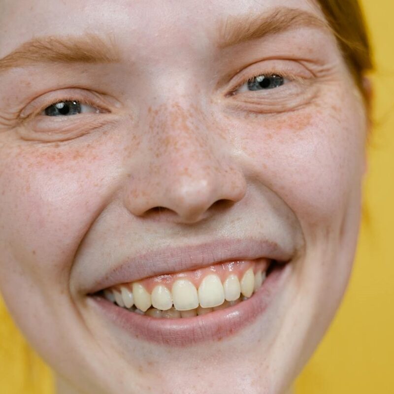 Sonrisa Gingival