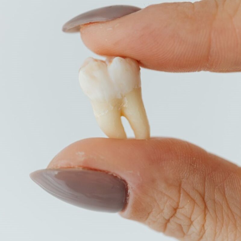 Muelas cordales | Clínica Dental Valencia Marien Morata Roig