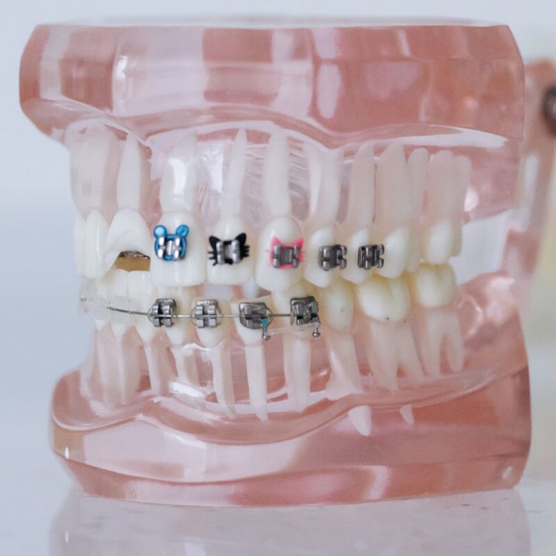 Ortodoncia y esmalte | Clínica Dental Valencia Marien Morata