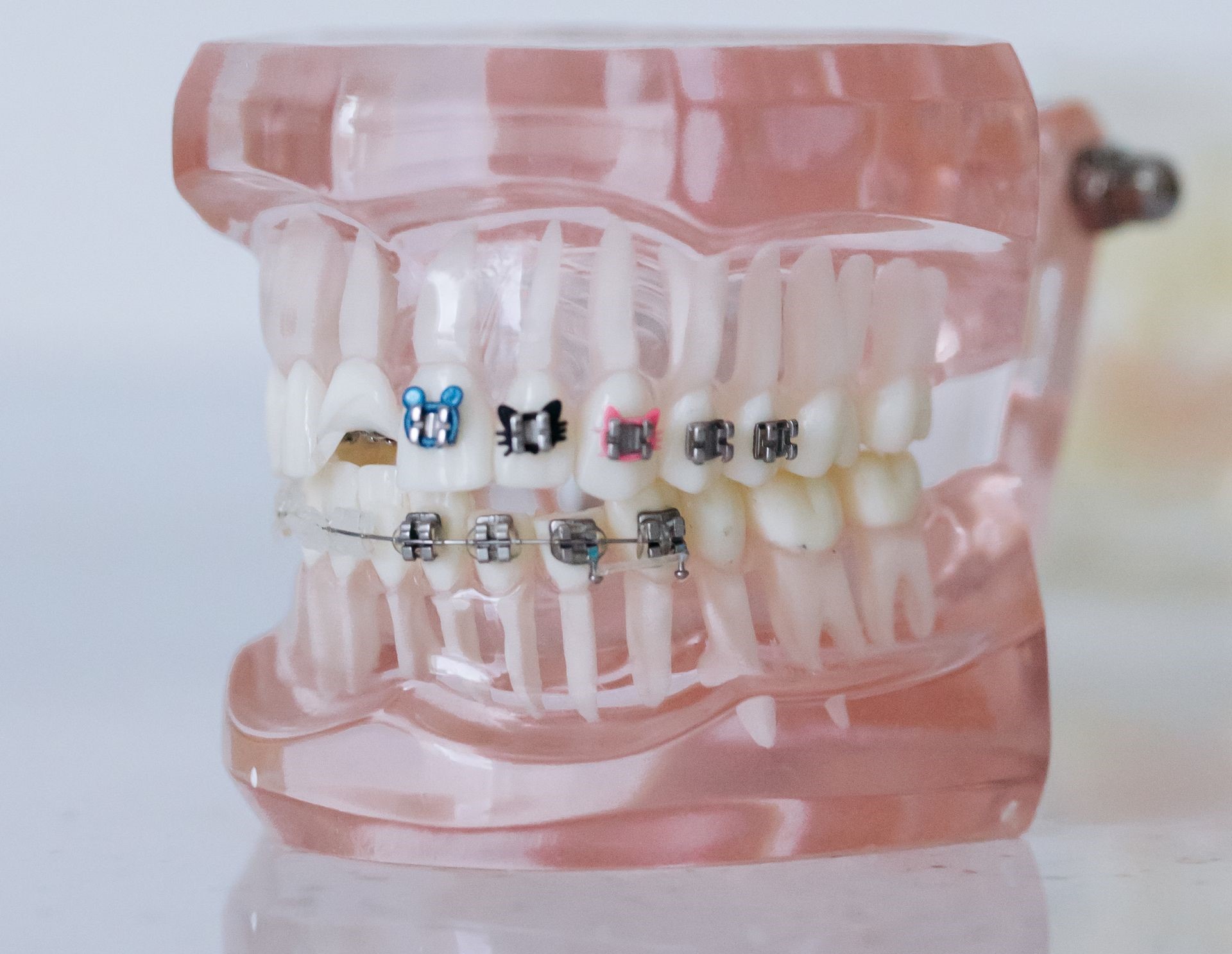 Una ortodoncia exitosa incluye un esmalte dental sano